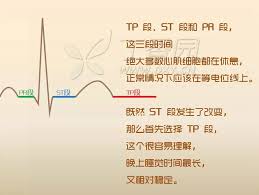 ST段抬高：医学含义与指示意义